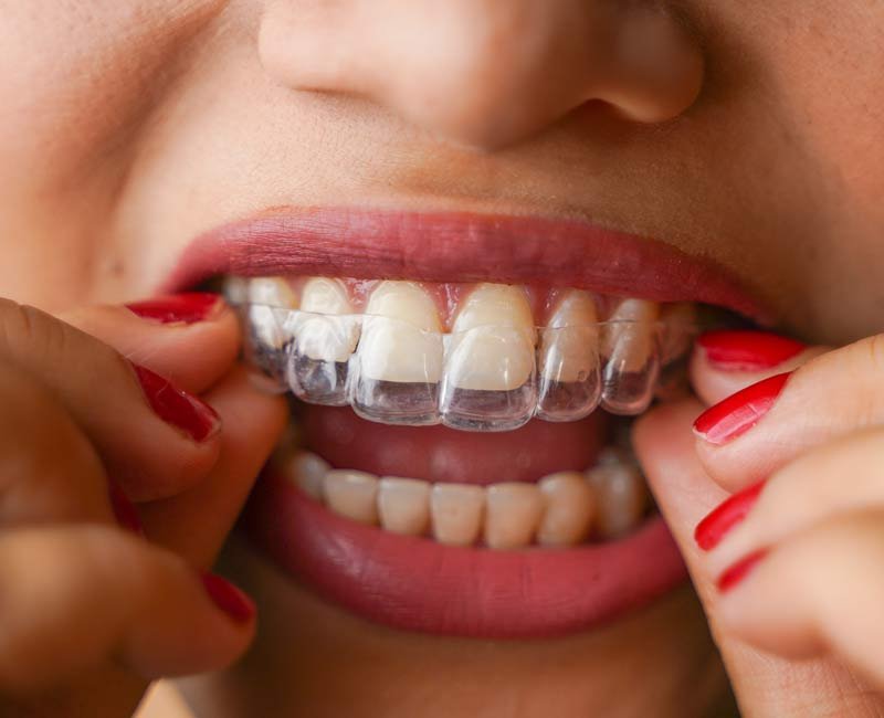 Orthodontic retainers