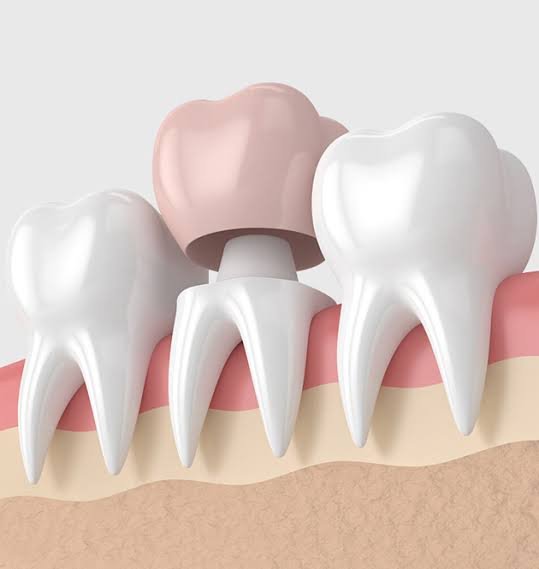 Root amputation and hemisection