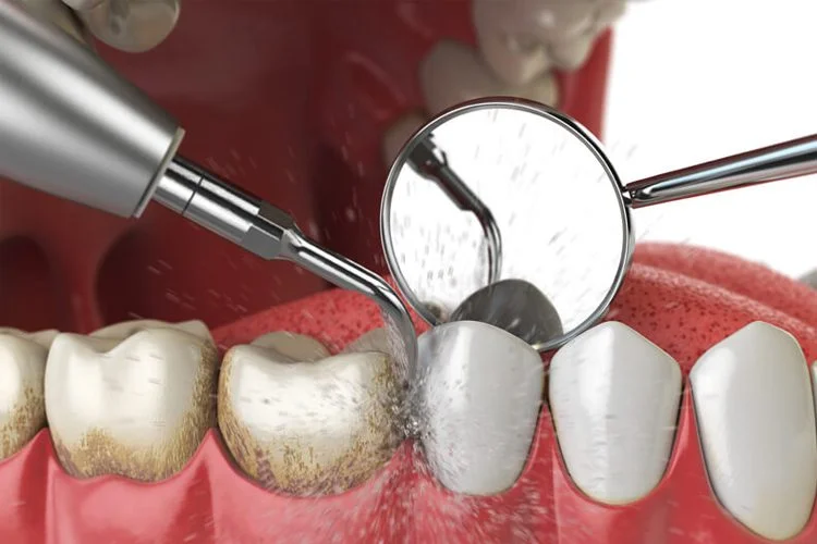 Scaling and air polishing treatment