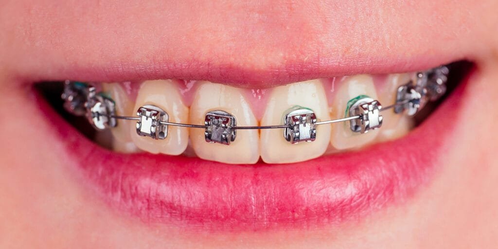 Self-ligating braces