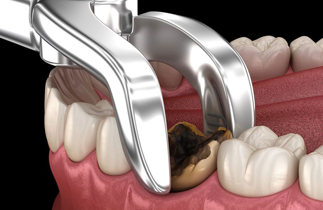 Simple tooth extraction