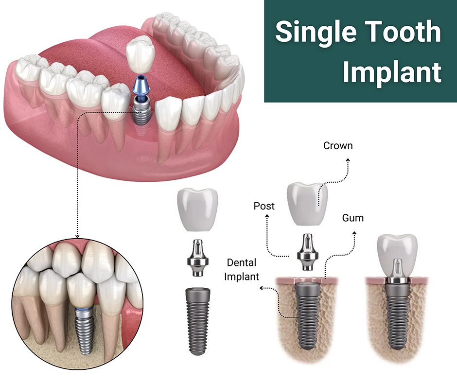 Single dental implant placement