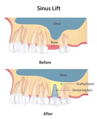 Sinus lift for dental implants