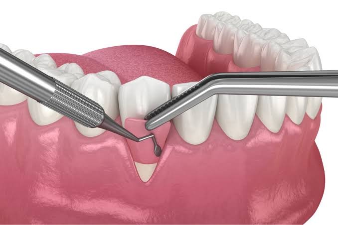 Soft tissue and gum grafting