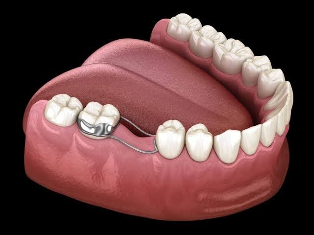 Space maintainer for premature tooth loss