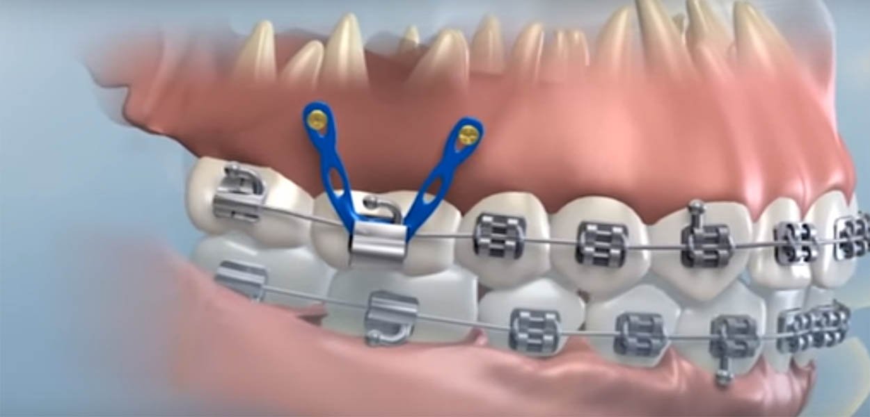 TADs and orthodontic mini-screws