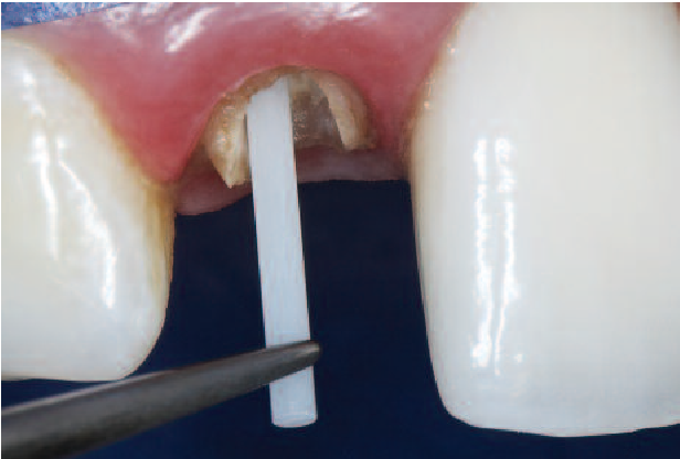 Post-and-core dental restoration