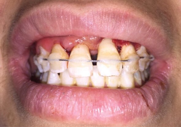 Dental-trauma management and splinting