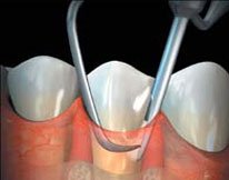 Pyorrhea and periodontitis treatment