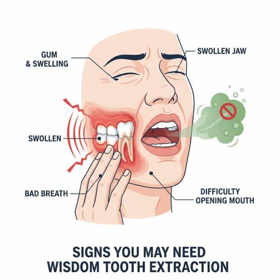 Wisdom tooth removal