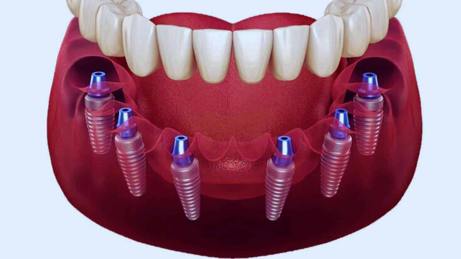 All-on-6 dental implants