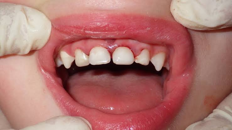 Strip crown and pediatric zirconia crown