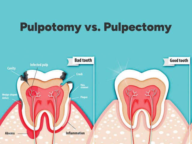 Pulp therapy for a primary tooth
