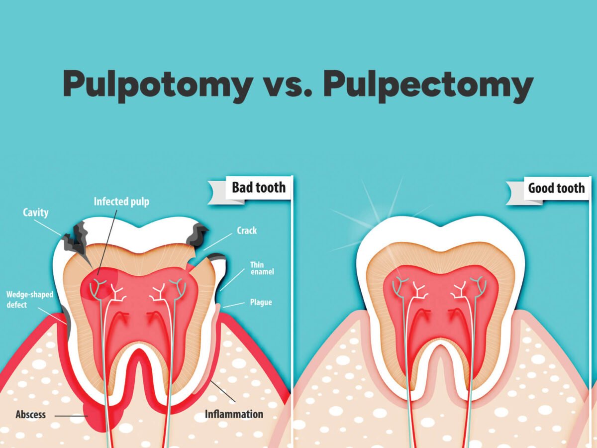 Pulpotomy and pulpectomy treatment for children