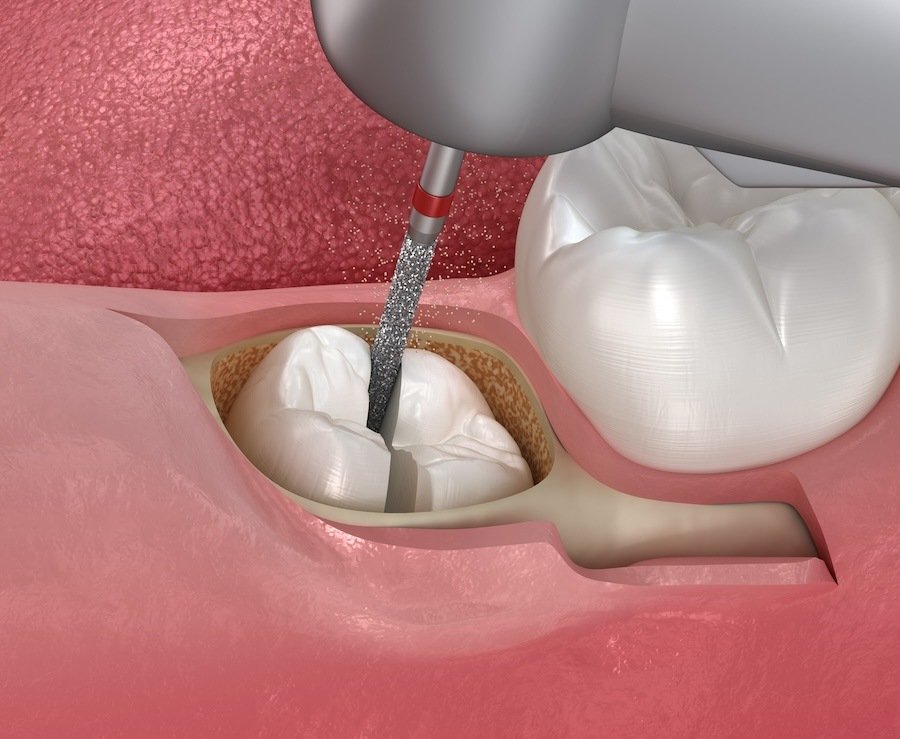 Dental professional preparing for oral surgery